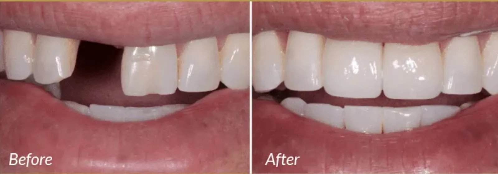 Dental Implants Leicester