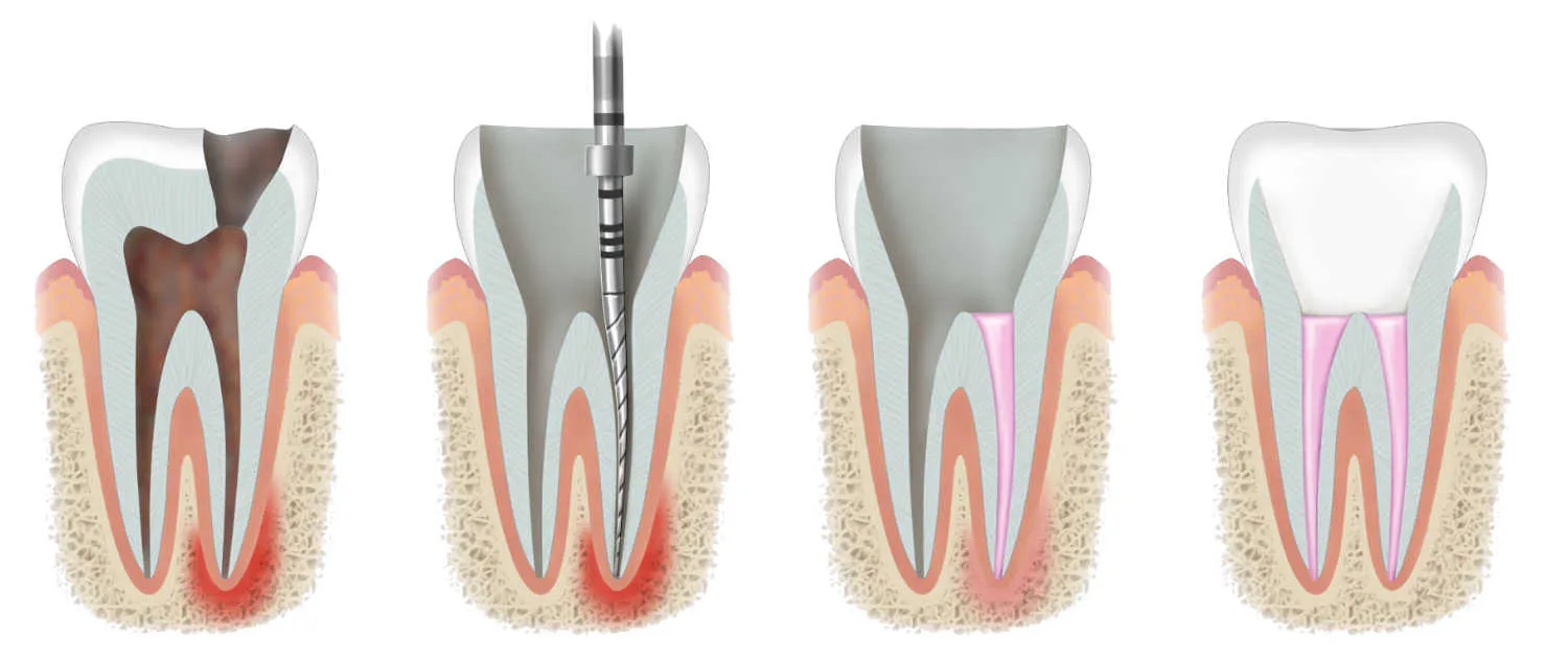 Root canal Leicester - Endodontist Leicester